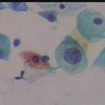 Κυτταρο ενδοτραχήλου με διογκωμένο πυρήνα.